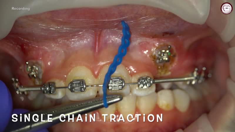 Exposure and traction of labial impacted canines, traction by power chain, amr asker ортодонтия