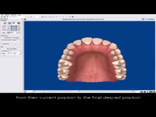 How does invisalign work