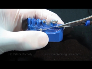 Biomecánica con mini implantes # 5 mesialización molar 1 ортодонтия миниимпланты