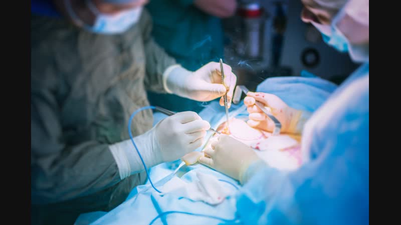 Лапароскопическая декомпрессия чревного ствола и лапароскопическая фундопликация