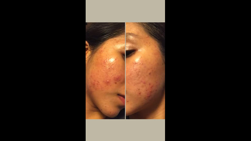 Mi problema de acné / my acne problem