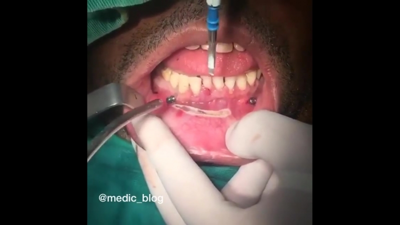 Фрагмент из операции на нижнюю челюсть из за перелома нижней челюсти