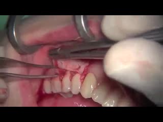 Bilaminar flap in periodontal plastic surgery with connective tissue