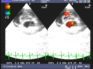 Echocardiogram of aortic dissection in a 18 years old maltese