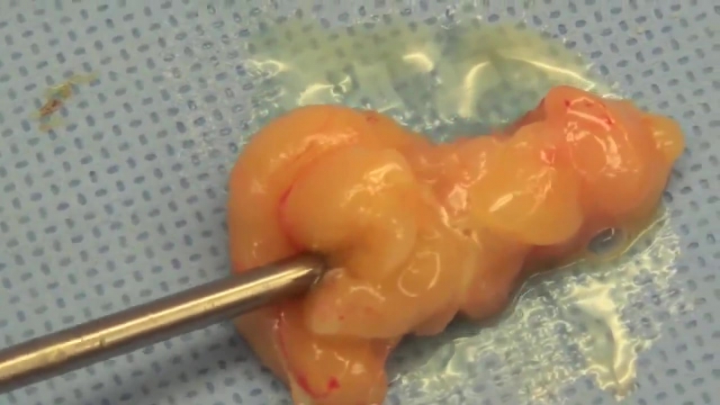 Ультразвуковая липосакция