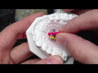 Setting an expansion screw in a retainer ортодонтия