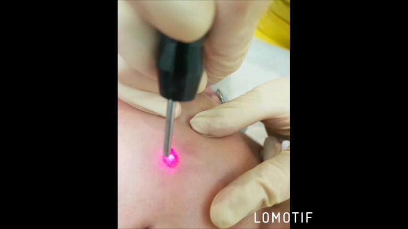 Удаление родинки