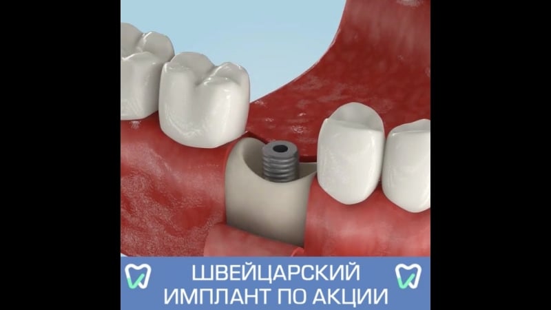 Швейцарский имплант по акции!