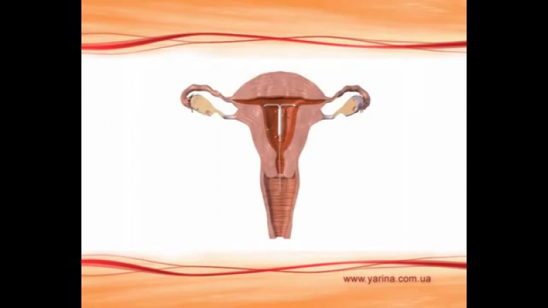 Внутриматочная спираль