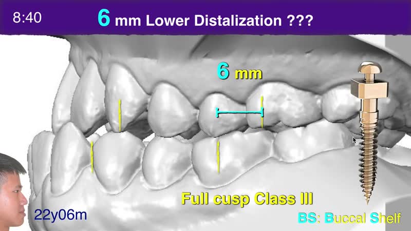 Chris chang screws for fixed appliances and aligners 2020 aao part i