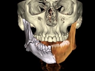 Виртуальная реконструкция перелома нижней челюсти хирургическая стоматология