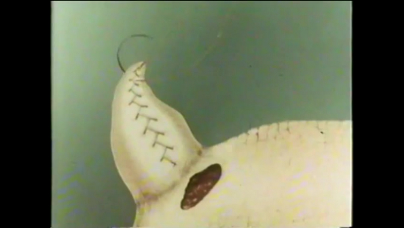 Резекция желудка ©