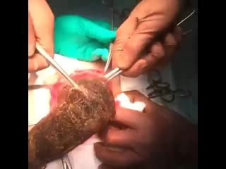 Извлечение безоара из желудка