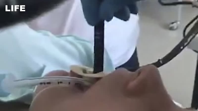 Метровая змея заползла в рот женщине в дагестане