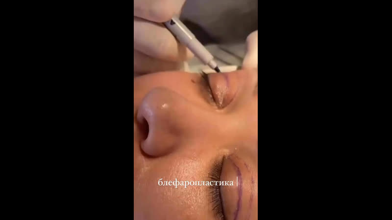 Блефаропластика