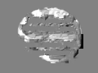 Brain lecture 3 frontal lobes frontal lobotomy, mania, depression