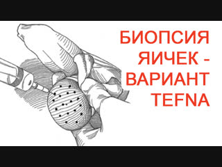 Биопсия яичек вариант tefna