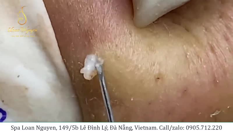 Удаление кисты на лице