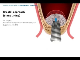 Crestal approach on upper molar area