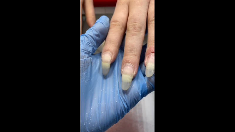 Откуда берутся отслойки что за чёрные точки переношенная длина