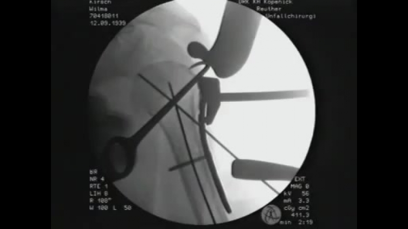 Остеосинтез перелома проксимального отдела плечевой кости