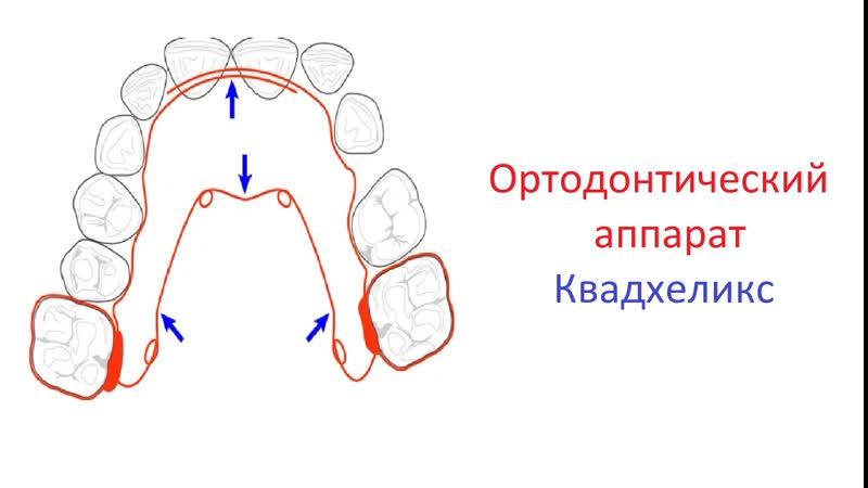 Ортодонтический аппарат квадхеликс (quad helix) принцип действия, активация