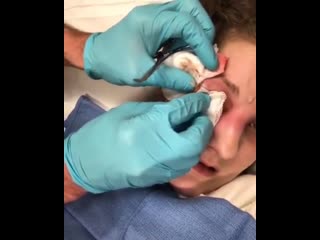 Периорбитальный целлюлит