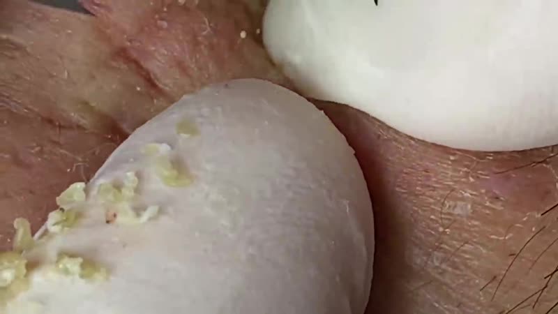 Подкожные угри, забитые поры