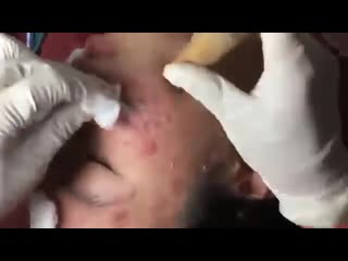 Угри, воспаленные прыщи