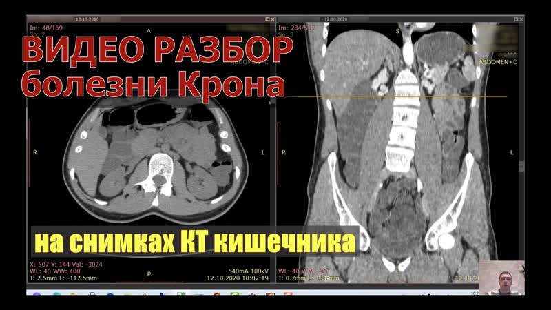 Видео разбор и оценка результатов кт кишечника при атипичной болезни крона после кт расшифрои