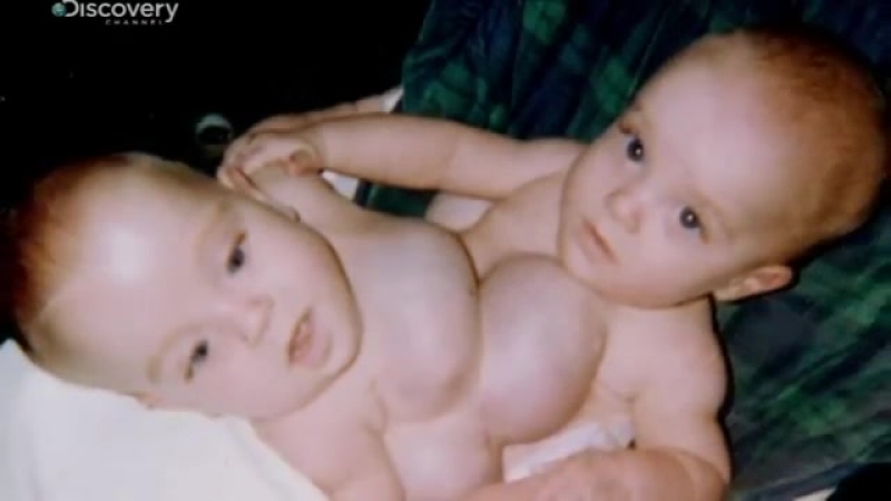Вот как выглядела после рождения самая невероятная тройня в мире картина не для слабонервных!