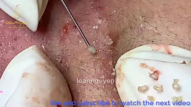 Угри porn video – Белые угри, черные точки, небольшие воспаления