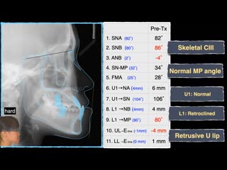 Chris chang ortho nonsurgical correction of a class iii malocclusion with miniscrews