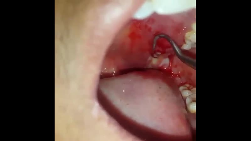 Абсцесс в полости рта