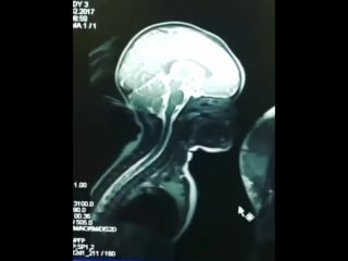 Мрт ребенку во время кормления грудью!