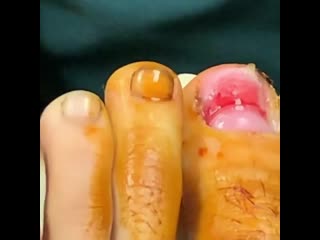 Удаление вросшего ногтя