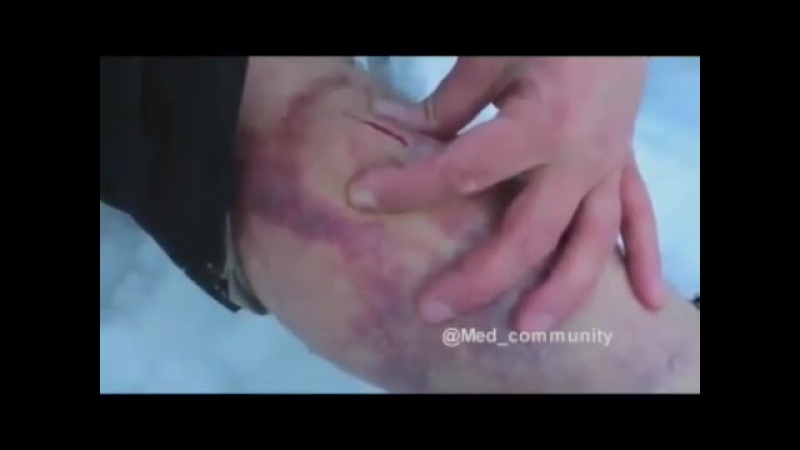 Самостоятельное удаление гематомы в полевых условиях