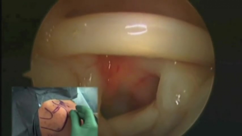 Техника инъекций в плечевой сустав