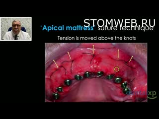 Apical mattress suture prevention of "oxidative stress" of bone & soft tissue