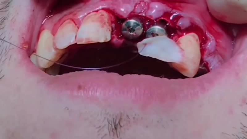 Немедленная имплантация, немедленная нагрузка