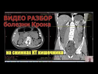 Видео разбор и оценка результатов кт кишечника при атипичной болезни крона после кт расшифрои