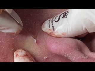 "тысяча выдавливаний", 8 сезон, серия 3 из 3