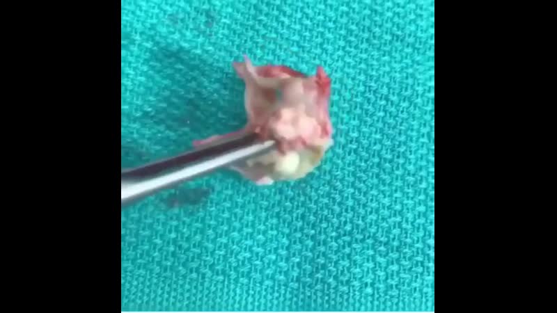 Аортальный стеноз