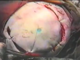 51 трепанация черепа