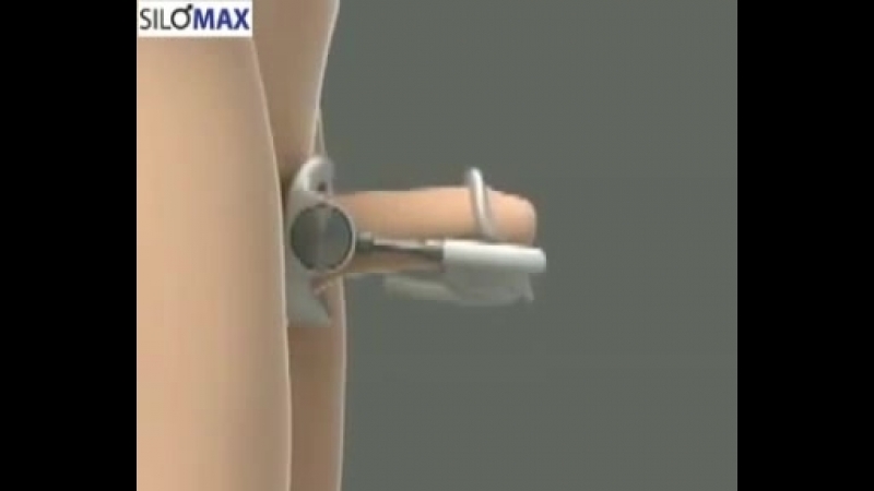 Экстендер (proextender) без вреда для здоровья