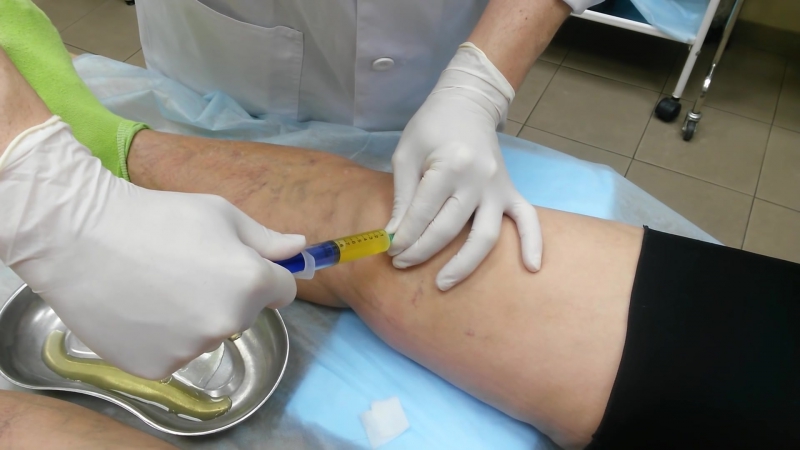 Лечение синовита коленного сустава (пункция)