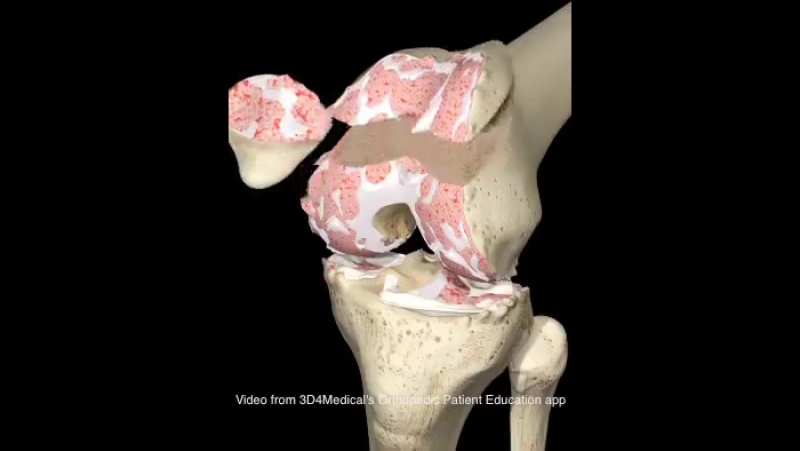 Эндопротезирование коленного сустава пример