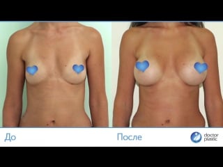 До и после увеличение груди выполнено в клинике doctorplastic