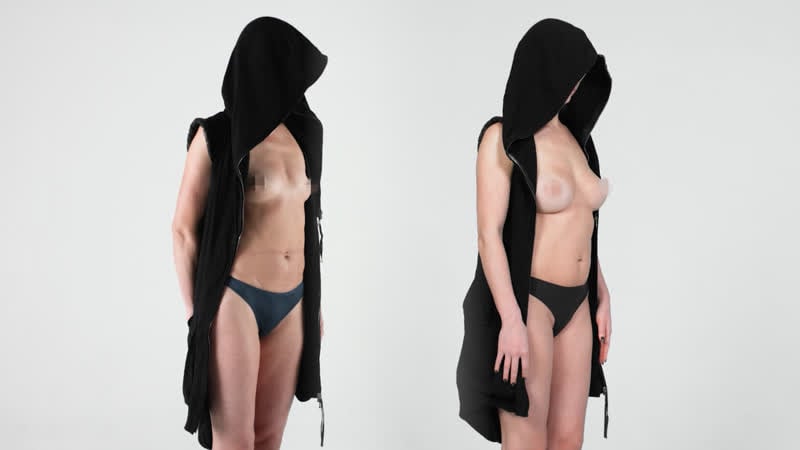 Увеличение груди с липофилингом хочу естественную грудь, но побольше