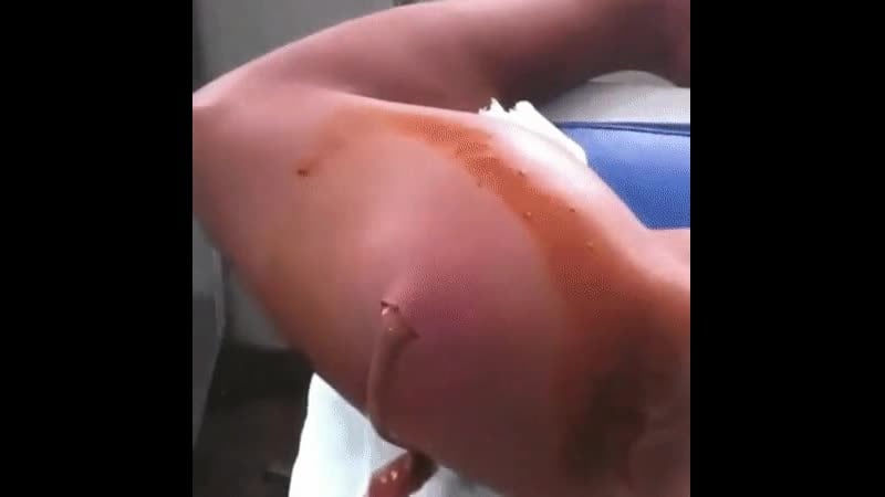 Разрез абсцесса